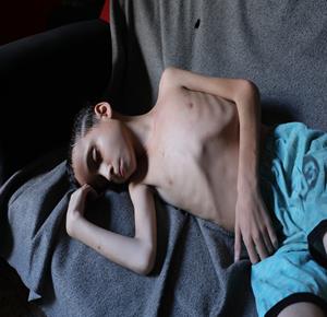 الطفل محمد حسين( 13 عامًا) يتلقى الرعاية من عائلته في منزلهم بمخيم البريج وسط قطاع غزة، حيث يعاني من سوء تغذية حاد يهدد حياته في ظل تدهور الأوضاع الإنسانية نتيجة العدوان الإسرائيلي والحصار المستمر